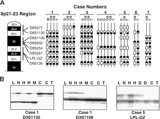Fig. 3. Examples of allelotyping analysis at the chromosome 8p21–23 region of normal epithelium and preneoplastic and neoplastic lesions accompanying resected squamous cell carcinomas using eight microsatellite markers. A, examples of the progression in the size of the chromosome region involved in 8p21–23 deletions in seven resected squamous cell carcinomas and their accompanying preneoplastic and noninvasive lesions. M, mildly abnormal bronchial epithelia (squamous metaplasia); D, dysplasia; T, invasive carcinoma., lower allele lost;, upper allele lost;, no LOH; line, not informative. Notice that the same allele is lost in preneoplastic, noninvasive, and invasive lesions. B, representative autoradiographs of microsatellite analyses for LOH at chromosomal regions 8p21–23 of three of the resected lung squamous cell carcinomas (cases 1 and 5) and their accompanying normal and precursor lesions represented in A. L, lymphocytes; N, histologically normal epithelium; H, hyperplasia; M, squamous metaplasia; D, dysplasia; C, CIS; T, invasive carcinoma. Notice that the same allele is lost in preneoplastic, CIS, and invasive cancer.