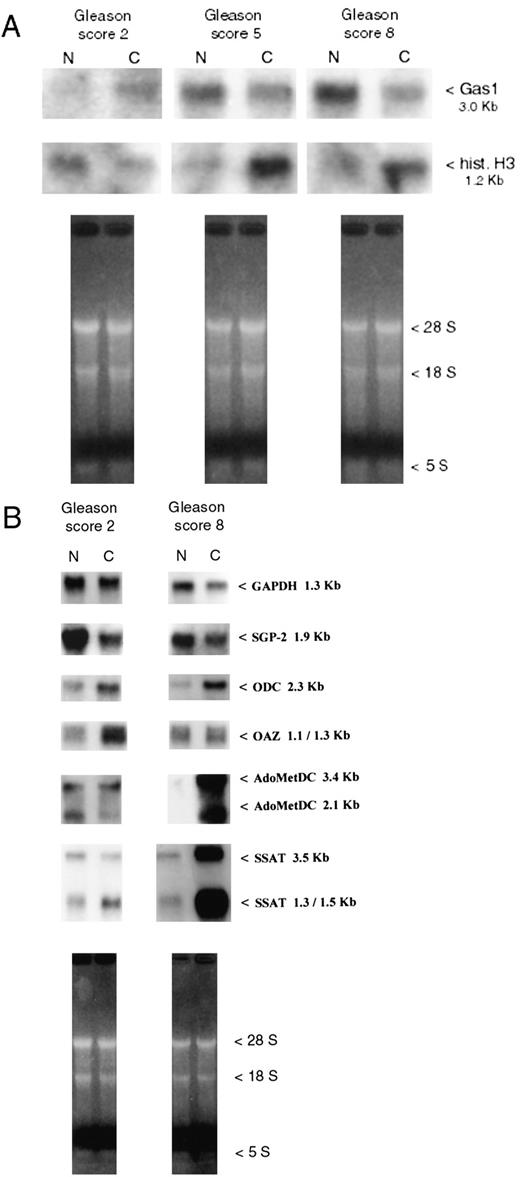 Fig. 1. Representative Northern blot autoradiograms of total RNA extracted from low (2 and 5) and high (8) Gleason score human CaP specimens (C), compared with the benign counterpart (N)from the same gland. The specific radioactive probes used for the hybridization and the size of the specific mRNAs detected are indicated. Ethidium bromide staining of the same RNA samples is shown for comparison (10 μg of total RNA were loaded on each lane and resolved by electrophoresis). A, histone H3 and Gas1 mRNAs; B,mRNAs coding for the regulatory proteins of polyamine metabolism, ODC,AdoMetDC, OAZ, SSAT, and clusterin (SGP-2). GAPDH mRNA is also shown for comparison.