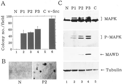 Fig. 2. Cytoplasmic hMAWD staining. A, using a specific anti-His antibody, His-tagged hMAWD was detected in the cytoplasm of the COS-7 cells only transfected with His-tagged full-length hMAWD (top panel). B, using the specific anti-hMAWD antibody, endogenous cytoplasmic hMAWD signals were detected in ECV304 cells (toppanel). C, dual-labeling with antibodies directed against hMAWD (top panel) or phospho-MAPK (middle panel) in COS-7 cells transfected with full-length hMAWD. Note that the distribution of phospho-MAPK follows the distribution of hMAWD. The bottom panels in A, B, and C were phase contrasts of the cells. The cells were inspected with a confocal scanning microscopy. D, positive immunoreactivity for hMAWD in the cytoplasm of an invasive ductal breast carcinoma by immunohistological staining.×400.