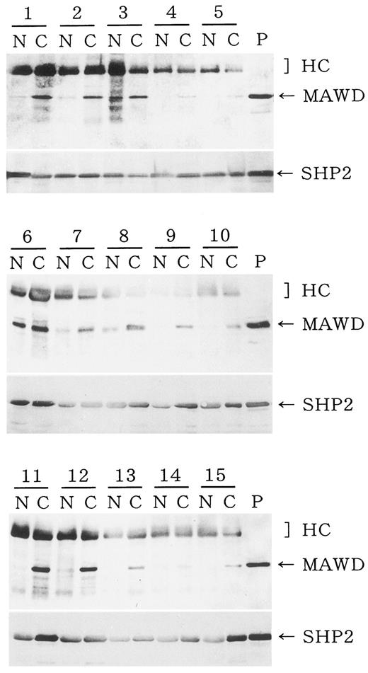 Fig. 4. Immunoblotting of the lysates from breast cancer tissues and the patient-matched normal tissues. Results of the representative 15 of 46 cases are shown. The tissues were lysed in RIPA buffer, and the lysates (50 mg) were analyzed by immunoblotting with anti-hMAWD antibody as described in “Materials and Methods.” All lanes show expression of hMAWD at various levels. P lane, positive control of hMAWD, which is expressed in COS-7 cells transfected with full-length hMAWD. The position of hMAWD protein is indicated by arrowhead on the right side. The SHP2 levels were almost constant throughout, showing that the loading and transfer of the samples were consistent.