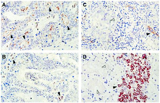 Fig. 2. Cryosections, stained with the BXP-34 Mab, of two small-intestine tumors (A, B); a testicular tumor (C); and a control section of normal human kidney, preinjected with a mixture of parental and MX-resistant MCF-7 MR breast cancer cells (D). Biotinylated rabbit-antimouse serum and HRP-labeled streptavidin were used as secondary reagents. Color development was with AEC. A,▴, BCRP staining of the epithelial cells of the neoplastic crypts. B, no staining is observed, except for some desmoplastic stroma staining (▴). C, the seminoma cells are negative (▵), but staining of the endothelial cells is observed(▴). D, no BCRP staining is observed in the kidney tubules (▵), whereas strong staining is observed in the MCF-7 MR cells in the injected tumor cell suspension (▴).