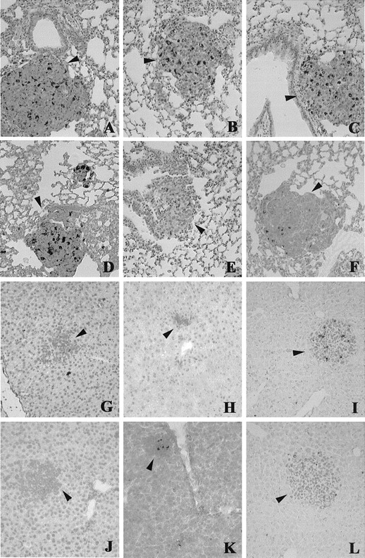 Fig. 3. Immunohistochemistry. Both B16-BL6 and M5076 cells(5 × 104 cells/mouse) were injected i.v. into NOS II+/+ (A–C and G–I) or NOS II−/− (D–Fand J–L) C57BL/6 mice. Lungs and livers were harvested and processed for staining for macrophages (A and D), NOS II (B, E, G, and J), PCNA (C, F, H, and K),and apoptotic cells (I and L). Arrowheads, tumor lesions.