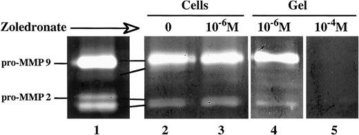 Fig. 4. The BP zoledronate does not inhibit MMP production by MDA-MB-231 breast carcinoma cells. The serum-free conditioned medium from 12-o-tetradecanoylphorbol-13-acetate-treated HT1080 fibrosarcoma cells was used as a positive control to identify MMP-9 and-2 on gelatin zymograms (Lane 1). Serum-free conditioned media of untreated (Lane 2) and zoledronate-treated(Lane 3) MDA-MB-231 cells grown on Matrigel were harvested, concentrated, and subjected to gelatin zymography. Alternatively, the serum-free conditioned medium from untreated cells was run on a SDS-polyacrylamide gel containing gelatin and zoledronate at a concentration of 10−6 (Lane 4) or 10−4 m (Lane 5). White bands indicate gelatinase activity.