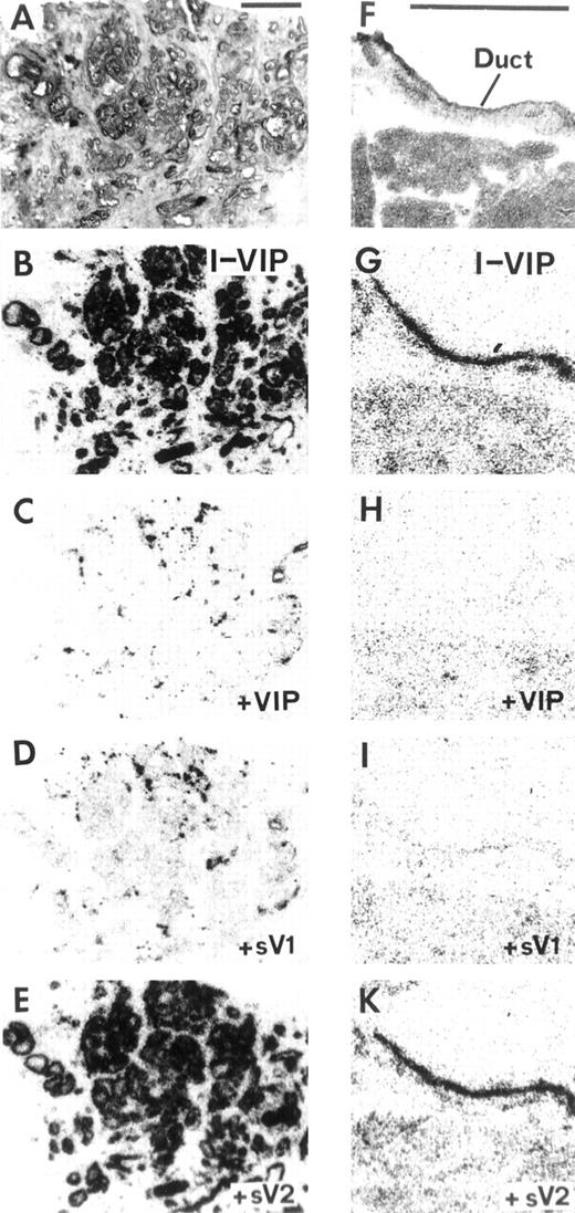 Fig. 2. VPAC1 in human ductal pancreatic carcinoma(A–E) and its tissue of origin, the pancreatic duct(F–K). A and F,H&E-stained sections. Bars, 1 mm. B–Eand G–K, autoradiograms showing 125I-VIP binding. B and G, 125I-VIP total binding. C and H, binding in presence of 20 nm VIP. D and I, binding in presence of 20 nm of the VPAC1-selective analogue (sV1) KRL-VIP/GRF. E and K, binding in presence of 20 nm of the VPAC2-selective analogue(sV2) RO 25-1553. Complete displacement by 20 nm KRL-VIP/GRF but not RO 25-1553 in the carcinoma and in the duct suggest the presence of VPAC1.