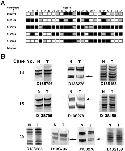 Fig. 1. LOH analysis on chromosome 13q33–34 in HNSCCs. A, schematic representation of LOH distribution. Case numbers are shown at the top. Microsatellite markers used to detect LOH are shown to the left. ▪, LOH; □,retention of heterozygosity; , not informative (homozygous). B, primary LOH data from three representative HNSCCs. N, normal DNA; T, tumor DNA. Cases 14 and 15 show LOH of marker D13S278 but retention of the flanking markers. Case 20 also shows LOH of markers D13S796 and D13S278 but retention of the flanking markers.