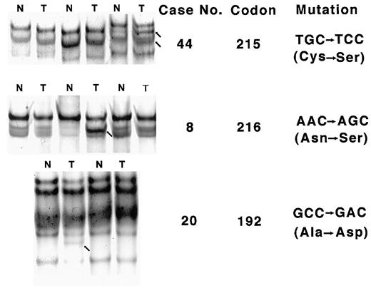 Fig. 3. SSCP analysis of the ING1 gene in genomic DNA from HNSCCs. SSCP analysis demonstrated the altered migration pattern of PCR products containing a mutated nucleotide. N, normal DNA; T, tumor DNA. Arrows point to the bands altered in tumor DNA as compared with the corresponding normal DNA. The aa substitutions of p33ING1b are shown to the right.