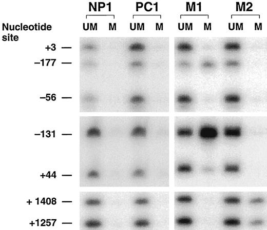Fig. 3. Methylation of the AR promoter in prostate tissues using Ms-SnuPE. Ms-SNuPE was carried out as described previously(27) to quantitatively assess the methylation status at individual CpG sites (Table 1)<$REFLINK>. Genomic DNA was first reacted with sodium bisulfite to convert unmethylated cytosine to uracil while leaving 5-methylcytosine unchanged. Amplification of the desired target sequence was then performed using PCR primers specific for bisulfite-converted DNA, and the resulting product was isolated and used as a template for single nucleotide primer extension. Fifteen hormone-independent prostate metastases and 10 paired normal/primary prostate cancers were tested. None of the normal or primary prostate cancers demonstrated methylation. Representative normal prostate(NP1) and primary prostate cancer (PC1)samples are shown with the individual CpG sites tested. Methylation was detected in two hormone-independent metastatic lesions. M1 was ∼ 70% methylated at CpG core promoter sites −177 and −131. M2, another metastatic lesion,demonstrated ∼30% methylation at +1257 and +1408 in exon 1. UM, unmethylated; M, methylated.