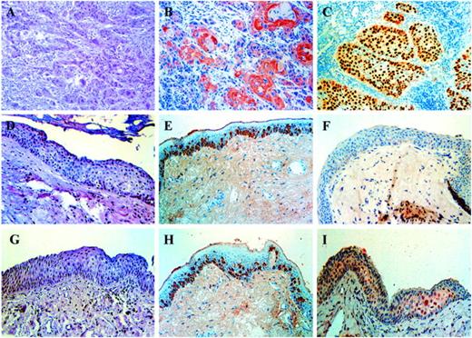 Fig. 1. Immunohistochemical staining of eIF4E and p53 in SCCs and surgical margins of the larynx. A, SCC, H&E stain, ×20. B, SCC with intense reddish brown perinuclear staining with anti-4E, ×20. C, SCC with intense brown nuclear staining with anti-p53, ×20. D, histologically“tumor-free” surgical margin with dysplasia, H&E stain, ×20. E, above margin with anti-4E stain, ×20. Note positive staining in the basal cell layer. F, same margin with anti-p53, ×20, no staining. G, histologically“tumor-free” margin, also with dysplasia, H&E, ×20. H, above margin showing reddish-brown perinuclear staining of the basal layer with anti-4E stain, ×20. I,same margin also showing brown nuclear staining for p53.