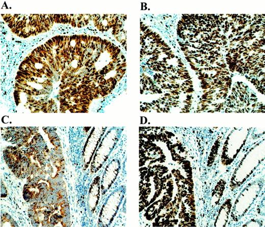 Fig. 5. Immunohistochemical localization of dUTPase in neoplastic human tissues. A, routinely processed human colon cancer(case 1) stained with DUT415. B, routinely processed human colon cancer (case 1) stained with Ki67. C,routinely processed human colon cancer (case 2) stained with DUT415. D, routinely processed human colon cancer (case 2)stained with Ki67.