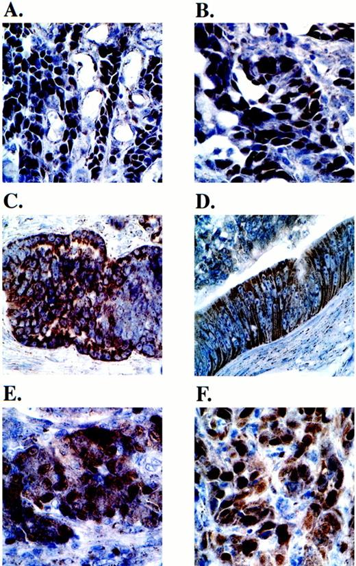 Fig. 6. Immunohistochemical localization of dUTPase in human colon cancers. Colon cancer tumor specimens were routinely processed and stained with DUT415. A and Billustrate exclusive nuclear dUTPase expression. C and D illustrate exclusive cytoplasmic expression. E and F illustrate a combination of nuclear and cytoplasmic expression.