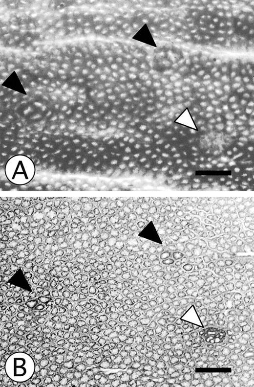 Fig. 1. Topographic view of methylene blue-stained mucosa of whole mount colons (A) and histological view of the corresponding area (B). A, ACF could be easily distinguished by their increased size, prominent epithelial cells, and increase of pericryptal space from surrounding normal crypts in colonic mucosa stained with methylene blue (arrows). B, two populations of altered crypts are histologically detected at the cross section. The first type has a macroscopic appearance resembling ACF (HACAs, arrows). The second type of altered crypts does not have the ACF-like appearance (HACNs). HACNs cannot be clearly distinguished from adjacent normal crypts in whole mount preparations. Occasionally, HACNs can be detected as a depressed mucosal lesion. Even in such cases, they lack the ACF-like appearance (open arrow). Bars, 250μm.