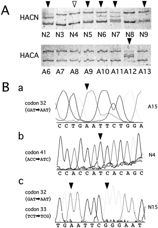 Fig. 2. Detection of β-Cateninmutations in HACAs and HACNs. A, SSCP analysis:Representative results of PCR-SSCP analysis of the rat β-catenin gene are shown. PCR products were electrophoresed on a 10% polyacrylamide gel containing 1%glycerol at 15°C. Lanes N2–9, samples of HACNs; Lanes A6–A13, samples of HACAs. Note that band shifts(closed arrows) are frequently recognized in HACNs,whereas they are rare in HACAs. B, DNA sequencing: The types of mutations are shown (a–c). All alterations identified are caused by single-nucleotide substitution and located within functionally significant phosphorylation sites on exon 3. Arrowheads, the nucleotide substitutions in histologically altered crypts. In case N15, double mutations in the same allele are observed (c). We detected one mutation(case N4) without the alteration in SSCP analyses (A, b, open arrow).