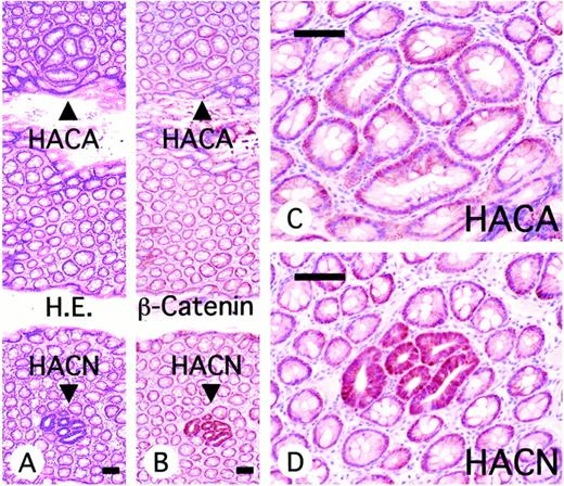 Fig. 3. Immunohistochemical analysis of β-catenin expression in histologically altered crypts. A, H&E(H.E.) staining. Two populations of histologically altered crypts (HACAs and HACNs) are present in cross sections. B, β-Catenin staining is immunohistochemically detected restrictedly to the membrane of the cell-to-cell borders in normal crypts. The overexpression of β-catenin is recognized in epithelium of HACNs, whereas it is hardly detected in HACAs. C, at higher magnifications, the stain in HACAs is selectively localized to the membrane of the cell-to-cell borders as seen in normal crypts. Note that HACAs had no cytoplasmic or nuclear immunostaining. D, β-Catenin overexpression and altered localization are present in HACNs. Strong immunopositivity is recognized in both cytoplasm and nuclei. In this case, the staining intensity was regarded as ++ in cytoplasms and + in the nucleus. Bars, 100 μm.