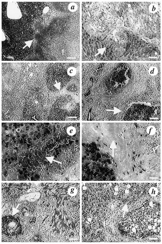 Fig. 1. H&E-stained sections from left lateral lobes of livers from mice. a, non tumor-bearing mouse injected i.v. with PIC followed 3 h later by 60 J of 666-nm interstitial light delivered at 100 mW, and sacrificed 4 days later. Bar,100 μm, showing a well defined border (arrow) between viable and necrotic liver and an inflammatory infiltrate. b, control tumor-bearing mouse received light but no PS; bar, 50 μm; arrow, islands of adenocarcinoma; no damage visible. c, tumor-bearing mouse received free ce6 and 80 J of light and sacrificed after 9 days; bar, 100 μm, showing nodules of viable adenocarcinoma are surrounded by fibrous stroma(arrow) and at the periphery, necrotic tumor. d-f, tumor-bearing mice received PIC and 80 J of light and sacrificed after 9 days. d,bar, 50 μm, showing an island of viable adenocarcinoma, containing mucinous glands, surrounded by zones of hemorrhagic and necrotic tumor (arrow) and necrotic liver tissue. e, bar, 25 μm showing viable carcinoma surrounded by areas of extensive hemorrhagic necrosis(arrow) and fibrosis. f, bar, 25 μm,showing viable carcinoma surrounded by fibrosis (arrow)and at the periphery, necrotic tumor. g, a mouse that was treated with PIT of 80 J delivered at 100 mW and which survived 92 days; bar, 50 μm, showing viable adenocarcinoma(arrow) surrounded by marked fibrosis and remnants of liver tissue. h, a mouse that had PIT with 10 J delivered at 30 mW and survived 39 days; bar, 50 μm,showing viable adenocarcinoma with large amounts of mucin, surrounded by liver tissue with nuclear pyknosis (arrow).