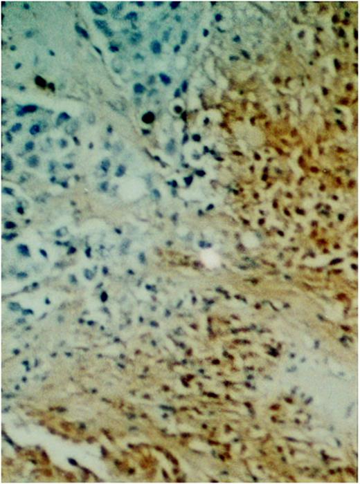 Fig. 5. Apoptosis immunolabeling in tumor tissue. Fig. 5<$REFLINK> shows a section (5 μm) of paraffin-embedded tumor tissue excised from a mouse 3 days after treatment with 10% paclitaxel-loaded paste. Tissue was immunolabeled (using the Apoptag kit) to identify apoptotic cells(brown-stained cells). Nonapoptotic cells may be visualized by the light blue methylene blue counterstain.