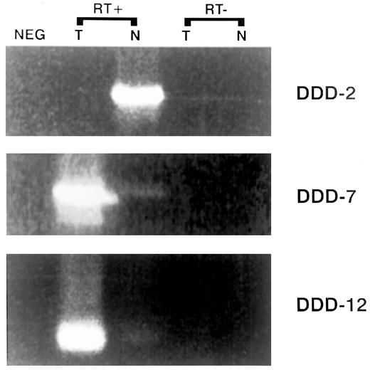 Fig. 1. RT-PCR validation of test hits identified by DDD. Three hits (creatine kinase MM-DDD2, guanylate cyclase 2C-DDD7, and ETS variant gene 3-DDD12) from Table 3<$REFLINK> were chosen for expression specificity using a matched set of normal- and tumor colon-derived random primed cDNAs synthesized in the presence (RT+) or absence of(RT−) reverse transcriptase. NEG, template minus negative control.