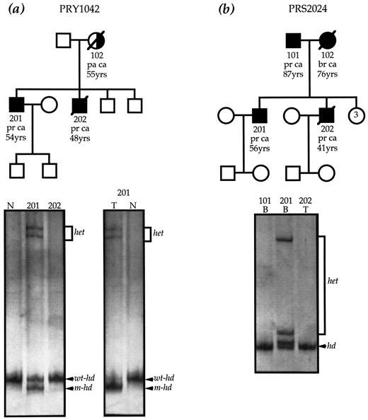 Fig. 2. a, the pedigree of family PRY1042. The mutation in this family, 6710delACAA, is detected as a heteroduplex variant (het) in index case 201. This variant is not present in the affected brother (202) or in a normal sample (N). pa ca, pancreatic cancer; pr ca, prostate cancer. Analysis of tumor DNA from individual 201 shows loss of the wild-type homoduplex DNA band(wt-hd) and retention of the shorter, mutant homoduplex band (m-hd). This is compared with wild-type homoduplex DNA seen in a normal sample (N). b, the mutation in family PRS2024, 5531delTT, was detected as a heteroduplex variant (het) and a homoduplex conformer(hd) in blood DNA from index case 201. This variant is not present in blood DNA from the affected father (101)or in tumor DNA (T) from the affected brother(202). br ca, breast cancer.