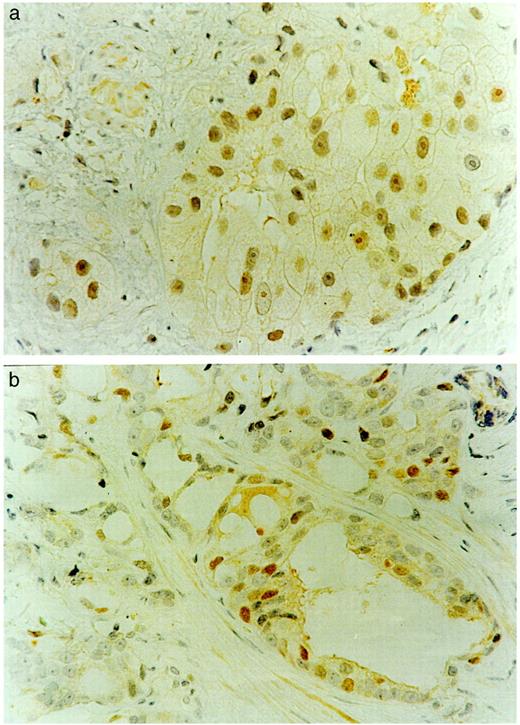 Fig. 3. a, prostate cancer cells from the brother(PRY1042.202) of the individual (PRY1042.201) who has a germ-line deletion (6710delACAA). This shows weakly positive staining with antibody to BRCA2 protein in individual 1042.202, who does not carry the mutation. (×400). b, multifocal areas of intense staining for antibody to BRCA2 protein in prostate cancer cells from the patient who has a polymorphism in BRCA2 (K2950N variant; ×400).