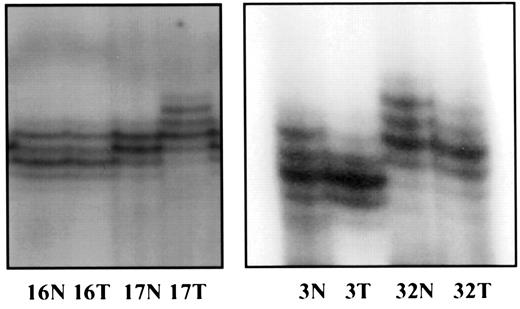 Fig. 2. MIN analysis with BUBCA18 in CRC samples. In each case, Lane N shows the DNA from normal colon, and Lane T shows DNA from the colonic tumor of the same patient. Patient 16 reveals heterozygosity for the marker. Patient 17 shows an allelic shift in the tumor (MIN). Patients 3 and 32 reveal allelic loss in the form of LOH.