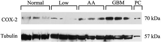 Fig. 1. Western blot analysis for COX-2 protein in glioma tissue specimens. Total protein (100 μg) was loaded into each lane. The bottom band is tubulin, which was used to demonstrate equal loading of protein in each lane. PC, positive control.