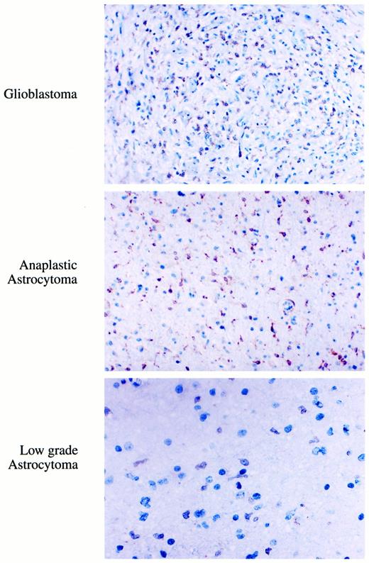 Fig. 2. Pattern of COX-2 expression in human glioma specimens. COX-2-positive staining increased in GBM and AA (×200) compared with LOW (×400).