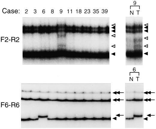 Fig. 2. RT-PCR-SSCP and sequence analyses of CHK2. Identification of an in vivo somatic CHK2mutation. Case 6 exhibited a distinct mobility shift only in the tumor specimen and not in the corresponding normal lung, whereas the mobility shift in case 9 was seen in both normal and tumor specimens.