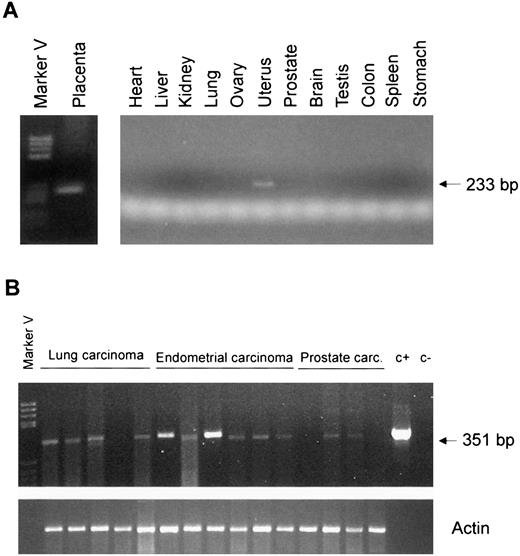 Fig. 5. Expression analysis of matrilysin-2 in normal and tumor tissues. A, PCR amplification of cDNAs from the indicated human tissues with primers mat2–1 and mat2–2. B, RT-PCR analysis of matrilysin-2 expression in the indicated tumors. A 351-bp fragment corresponding to a segment of matrilysin-2 was amplified with primers mat2–6 and mat2–9 in a volume of 50 μl, and 10 μl of the reaction were separated on a 2% agarose gel run in Tris-borate-EDTA buffer. Amplification of β-actin was used to ascertain RNA integrity and equal loading. c+ and c−, positive and negative control, respectively. Marker V (Boehringer-Mannheim) was used as a size marker.