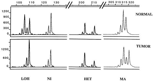 Fig. 1. Representative allelotyping output data. Top, normal B lymphocyte cell line; bottom, HCC366 lung cancer cell line. Each PCR product of a given size is represented by a major peak with minor peaks(stutter bands) on the left. The left scale (in arbitrary units) represents the intensity of the peaks. The size (in bp) is shown above the figure.