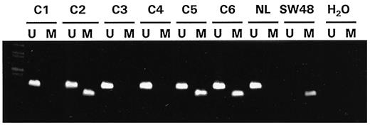Fig. 1. Hypermethylation of the hMLH1 promoter region CpG island in human IBD neoplasms. The presence of PCR product in lanes marked U indicates unmethylated hMLH1; product in lanes marked Mindicates hypermethylated hMLH1. All of the primary tumors display unmethylated bands presumably contributed by contaminating normal cells. Molecular size marker lane is at left. C1-C6 represent 6 of the 13 MSI-H IBD neoplasms. Samples C2, C5, and C6 are hypermethylated,whereas samples C1, C3, and C4 are unmethylated. Known hypermethylated SW48 cancer cells serve as positive controls, whereas unmethylated normal lymphocytes (NL) serve as negative controls. H20, water control (lacking genomic DNA).