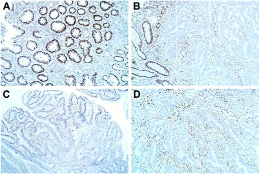 Fig. 2. hMLH1 protein expression assessed by immunohistochemical staining in hypermethylated MSI-high IBD neoplasms. A,low-power view of normal colonic mucosa, expressing abundant brown-staining hMLH1 protein in epithelial cell nuclei. B, low-power view of MSI-H IBD neoplasm with absent hMLH1 protein in neoplastic cell nuclei but abundant protein in adjacent normal glandular and stromal cell nuclei. C and D, low-power views of two different MSI-H IBD neoplasms with hypermethylation of hMLH1, showing absent hMLH1 protein in neoplastic cell nuclei.