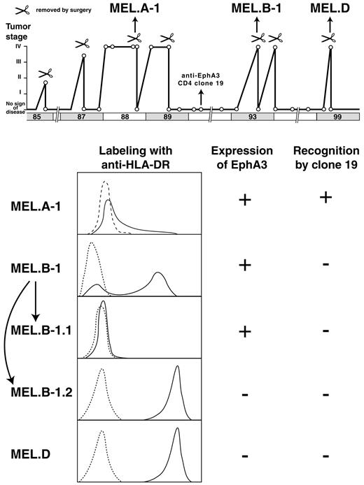 Fig. 8. Clinical evolution of melanoma patient LB33 and analysis of cell lines and clones derived from three metastases. Expression of EphA3 was tested with RT-PCR as in Fig. 6<$REFLINK>. + and −, a level of expression similar to that found in MEL.A-1 cells or no detectable expression, respectively. Recognition by CD4 clone 19 was tested by measuring the production of GM-CSF by the T-cell clone. The tumor cells were not treated with IFN-γ for these experiments.