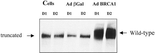 Fig. 3. Expression of wild-type BRCA1 in recombinant AdRSVBRCA1-infected cells. HCC 1937 cells were mock infected(Cells), infected with AdRSVβgal (Adβgal) or AdRSVBRCA1 (Ad BRCA1) for 4 h, and cell extracts were prepared 24 h (D1) or 48 h (D2) later. The endogenous mutant BRCA1 protein produced in HCC1937 cells displays an altered electrophoretic mobility because of the presence of 73 irrelevant residues in the place of the genuine 107 COOH-terminal amino acids (arrows). The zero time for the kinetics of 8-oxoG repair corresponds to the 24-h time after infection by the recombinant adenovirus.