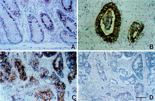 Fig. 1. Reactivity of mAb LM 389 with paraffin-embedded tissue sections using the avidin-peroxidase technique. Sections are counterstained with hematoxylin. A, normal human colon epithelial cells showing strong perinuclear reactivity of mAb LM389. B, colonic adenocarcinoma with strong staining of cancer cells and intraluminal material. C and D,O-glycoprotein endopeptidase treatment of colonic adenocarcinoma serial sections, control without enzyme(C), enzyme-treated section (D). Bar, 100 μm (A, C, and D) and 50 μm (B).