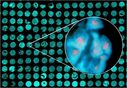 Fig. 3. Analysis of gene amplification in primary breast tumors by FISH to a tissue microarray containing 372 tumor samples. Part of the 4′,6-diamidino-2-phenylindole-stained tissue microarray is shown,illustrating the structure of the array with cylindrical tissue samples. The inset shows a selected area from a tumor with high-level amplification of TBX2.
