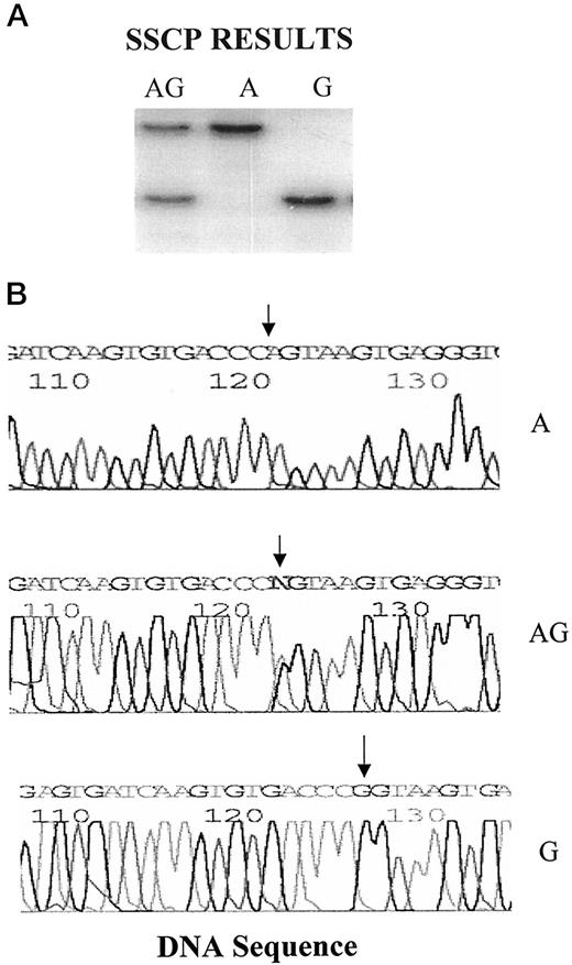 Fig. 1. Representative screening for the cyclin D1genotypes. A, patterns detected for each of the three genotypes AG, AA, and GG, when screened by SSCP analysis. B,results of nucleotide sequence analysis that allowed us to determine the genotype for each of the patterns. Arrows, the location of the nucleotide at which the polymorphism occurs.