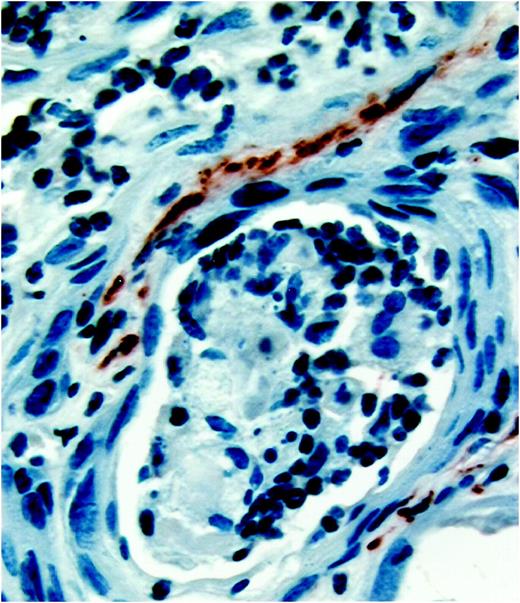 Fig. 3. COX-2 is markedly expressed in the vasculature within and adjacent to urinary bladder tumors in mice. Tissues were processed by standard immunohistochemical techniques and stained for COX-2.