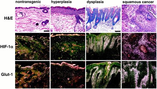 Fig. 1. Increase in HIF-1α and GLUT-1 mRNAs during spontaneous multistage carcinogenesis in K14-HPV16 transgenic mice. Neither HIF-1α nor GLUT-1 message is detectable in nontransgenic chest skin. At 16 weeks of age, hyperplasia and low-grade dysplasia are evident in chest skin, and both HIF-1α and GLUT-1 mRNAs are just detectable in skin lesions of this histological grade. By 32 weeks of age,hyperproliferative follicular-interfollicular dysplasias(21) are evident in chest skin. These premalignant precursors display a marked increase in both HIF-1α and GLUT-1 mRNAs localized to keratinocytes in the interfollicular basal layer, and the follicular ORS. In invasive epidermal squamous cancers, there is a further increase in HIF-1α and GLUT-1 mRNAs localized to the squamous component of the malignancies. Bars: nontransgenic and hyperplastic panels, 50 μm; dysplasia and squamous cancer panels, 100μm.