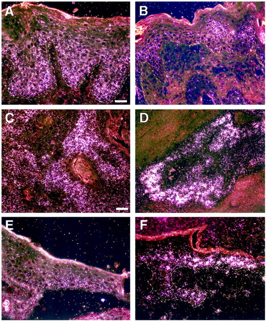 Fig. 2. Comparison of HIF-1α and VEGF expression patterns during multi-stage epidermal carcinogenesis and wound healing. In high-grade, hyperproliferative follicular/interfollicular chest dysplasias (21), HIF-1α mRNA is localized to the basal and immediate suprabasal layers (A), whereas VEGF mRNA(B) is distributed in the upper spinous and lower granular cell epidermal layers (sections from different, but similar,lesions). In carcinomas, both HIF-1α (C) and VEGF(D) mRNAs are further up-regulated, but whereas HIF-1αexpression is diffuse, VEGF mRNA is punctate, with marked signal increase in individual malignant squamous cells. During wound reepithelialization, HIF-1α mRNA is diffusely expressed in basal keratinocytes (E), whereas VEGF mRNA (F)is punctate and is present in granular as well as the basal cell layers. Bars: A, B, E, and F, 30 μm; C and D, 60μm.
