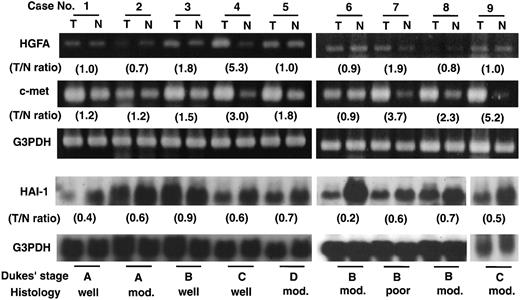 Fig. 4. Comparative results of mRNAs expression of HGFA,c-met, and HAI-1 in colorectal carcinomas and corresponding normal mucosa. HGFA and c-met were analyzed by RT-PCR study (28 cycles of amplification, as mentioned in“Materials and Methods”), and HAI-1 was by RNA blot analysis. The signals obtained were normalized by the corresponding G3PDH signal, and ratio of T:N (T/N ratio) was calculated. RT-PCR for G3PDH was 23 cycles of amplification. Cases 3, 4, and 9 correspond to 1, 2, and 3 in Fig. 1<$REFLINK>, respectively.