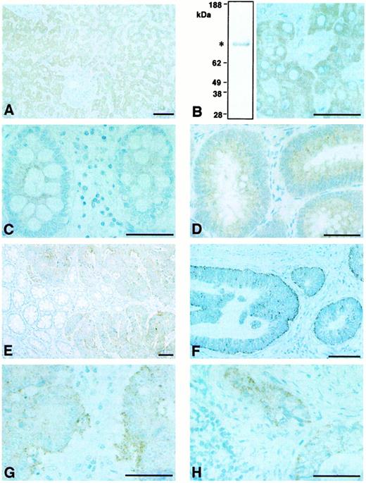 Fig. 5. Representative immunohistochemical analysis of HGFA in human liver (A and B), colorectal normal mucosa (C), adenoma (D), carcinomas(E–G), and lymph node metastasis(H). An immunoblot for HGFA in the extract of liver tissue using the same antibody (A1) is also shown in Bin which a single major band of Mr 96,000 pro-HGFA was observed. Note that HGFA reactivity in carcinoma cells frequently shows basal distribution. Hematoxylin counterstain. Bars, 100 μm.