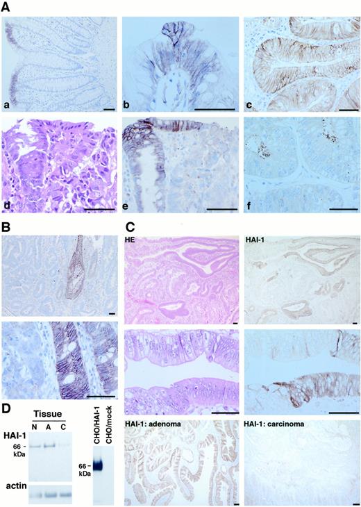 Fig. 6. Immunohistochemical detection of HAI-1. A,immunohistochemistry of normal colon (a and b), low-grade tubular adenoma (c), and carcinomas (e and f) of colon. Hematoxylin counterstain. A photo of H&E stain corresponding to e is shown in d. Bar, 100μm. B, up-regulation of HAI-1 in normal epithelium left behind in cancer tissue. In contrast, carcinoma cells are stained only faintly. Hematoxylin counterstain. Bar, 100 μm. C, HAI-1 expression in adenocarcinoma arising within adenoma (top four photos) and adenoma and invasive carcinoma present in a single tissue specimen (bottom two photos). In the former case, adenoma cells are stained more eosinophilic with H&E stain, whereas carcinoma cells have clearer cytoplasm. HAI-1 immunostain clearly highlighted the adenoma cells because of significant reduction of the immunoreactivity in carcinoma cells (top four photos). Bottom two photos, HAI-1 immunostain of low-grade adenoma and invasive carcinoma in a single specimen of a familial adenomatous polyposis case. Apparently, HAI-1 immunoreactivity is reduced in carcinoma compared with adenoma. Bar, 100 μm. D,immunoblot analysis of HAI-1 in tissue extracts of carcinoma(C), adenoma (A), and corresponding normal (N) mucosa using 1N7 antibody. Mr 66,000 of transmembrane form of HAI-1 was present in all specimens, and the levels of expression were decreased in carcinoma tissues. Twenty μg of extracted proteins were loaded in each lane. Cell extracts of HAI-1 cDNA-transfected CHO cells and mock-transfected CHO cells were used as positive and negative controls,respectively.