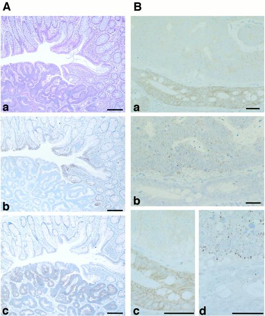 Fig. 7. Representative results of reciprocal expression pattern of HAI-1 (A, b, and B, a and c) and HGFA (A, c, and B,b and d). Both cases (A and B) are Dukes’ A stage. A photo of H&E stain corresponding to A, b and c is shown in A, a. Hematoxylin counterstain. Bar, 100μm.