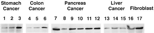 Fig. 3. Western blot analysis of Akt expression. Cell lysates, 20μg each, were loaded into each well and fractionated by 12%SDS-PAGE. Western blot analysis was performed using Akt antibody (New England BioLabs). The following stomach, colon, liver, and pancreatic cancer cell lines and normal fibroblasts are shown from left to right as follows: stomach cancer(Lanes 1–3), MKN28, MKN74, and MKN45, respectively;colon cancer (Lanes 4–6), DLD-1, WiDr,and SW-480, respectively; pancreatic cancer (Lanes 7–12), PANC-1, AsPC-1, PSN-1, KP-3, BxPC-3, and MiaPaCa-2;liver cancer (Lanes 13–16), Hep G2, Hep 3B, HLE, and HuH-7; and normal fibroblasts (Lane 17), HF.