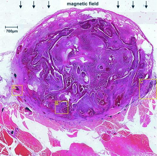Fig. 12. Illustration of a cross-section of VX-2 squamous cell carcinoma of the rabbit immediately after magnetic drug targeting. Brown-black particles, FFs scattered within the complete tumor. Yellow frames, areas that are described in more detail in Figs. 13<$REFLINK>, 14<$REFLINK>, and 15<$REFLINK>.