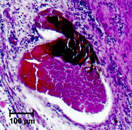 Fig. 13. Section A from Fig. 12<$REFLINK>. The vessel supplying the tumor shows an intramural concentration of FFs oriented toward the magnetic field.