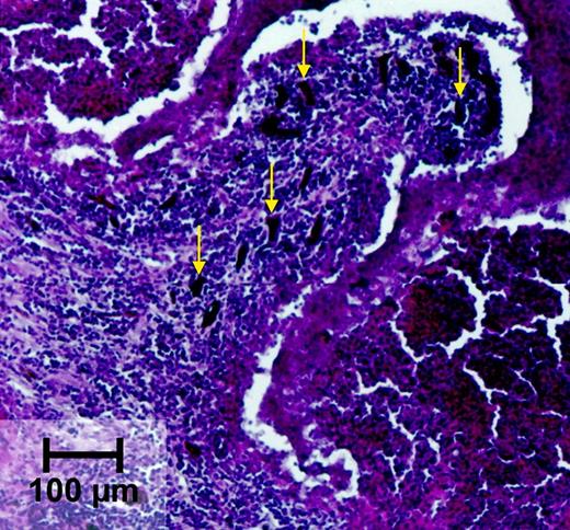 Fig. 14. Section B from Fig. 12<$REFLINK>. Yellow arrows, tumor tissue with interstitial FF concentrations.