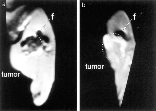 Fig. 16. MRI of tumorous (VX-2 carcinoma) hind limbs of rabbits after i.a. (a) and i.v. (b) application of FFs with 60-min exposure time to external magnetic field. The MR images were taken 6 h later still showing stable concentration of FFs within the area of interest.