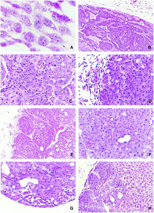 Fig. 2. Histopathology of MidT2 cells and syngeneic tumors. A, morphology of MidT2-1 cells in vitro(×1000). B, mammary tumor from a female MMTV-PyV MidT transgenic mouse (×200). C, mammary tumor from a female MMTV-PyV MidT transgenic mouse (×400). D, lung metastasis from a female MMTV-PyV MidT transgenic mouse (×400). E, MidT2 tumor in mammary fat pad of a female FVB mouse(×200). F, MidT2 tumor in mammary fat pad of a female FVB mouse (×400). G, lung metastasis from a primary MidT2 mammary fat pad tumor in a female FVB mouse (×400). H, i.p. MidT2 tumor invading the liver of a female FVB mouse (×200).