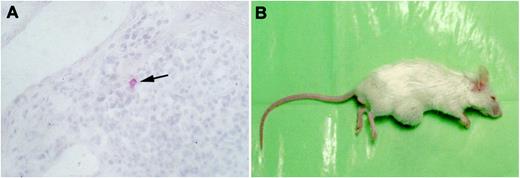 Fig. 2. A, cryostat section of left gastric artery lymph node with a red-stained isolated Ber-EP4-positive tumor cell. B, local tumor formation after s.c. injection of LN1590 cells into an immunodeficient SCID mouse.