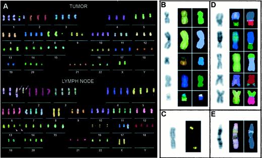 Fig. 3. Summary of characteristic aberrations in the cell line derived from the primary tumor (PT1590) and in lymph node micrometastases (LN1590). A, true-color M-FISH representations of characteristic karyotypes of a metaphase spread derived from PT1590 and LN1590 cells. Arrows, insertional translocation in LN1590. Arrowheads, corresponding deletion on chromosome 13. For details see text. In B, D, and E is the DAPI image shown in the first column, the true color representation in the second column, and the classification color in the third column. B, summary of structural rearrangements observed in both PT1590 and LN1590 cells. First row:del(5)(q1?3q2?2); second row:der(8)(qter→q1?::p2?→qter); third row:der(9)del(9)(p21∼22→q21∼22 ); fourth row:der(17); fifth row: der(22)t(19;22). C,hybridization of a YAC-specific for chromosome bands 8q24.2-3 to the derivative chromosome 8 occurring in PT1590 and LN1590 cells. First column: DAPI image; second column:hybridization image of the 8q-YAC. D, structural aberrations that were observed in ∼50% of PT1590 cells but not in LN1590 cells: First row: der(1)t(1;20); second row:der(3)t(3;17); third row: der(8)t(5;8); fourth row: der(10)t(1;10); fifth row: der(13)t(5;13). E, a structural aberration that was detected in all LN1590 but not in PT1590 cells. Insertion of chromosome 13 material in the short arm of chromosome 1 is shown.